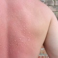 The Dangers of Second-Degree Sunburns: Symptoms, Treatment, and Long-Term Effects