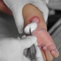 Exploring Denuded Skin Wound Meaning for Second-Degree Burns and Proper Care