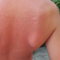 When to Seek Medical Attention for Second-Degree Sunburn: An Expert's Perspective