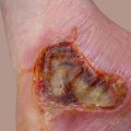 Understanding Third-Degree Burns: What You Need to Know