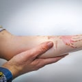 The Dangers of Leaving a Second-Degree Burn Untreated