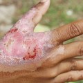 Expert Insights: Understanding the Different Degrees of Burns