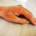 The Different Degrees of Burns: Understanding and Treating Them