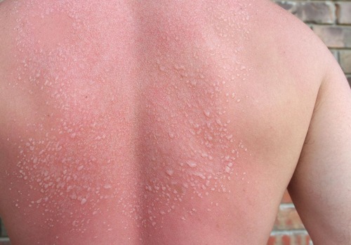 The Dangers of Second-Degree Sunburns: Symptoms, Treatment, and Long-Term Effects