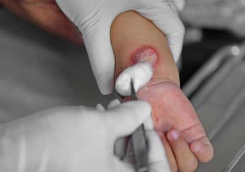 Exploring Denuded Skin Wound Meaning for Second-Degree Burns and Proper Care