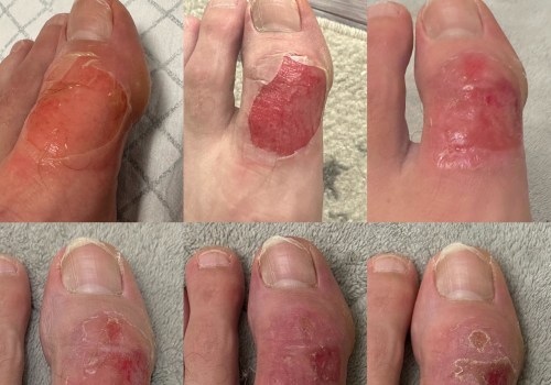 The Healing Journey of Second-Degree Burns