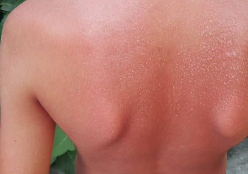 When to Seek Medical Attention for Second-Degree Sunburn: An Expert's Perspective