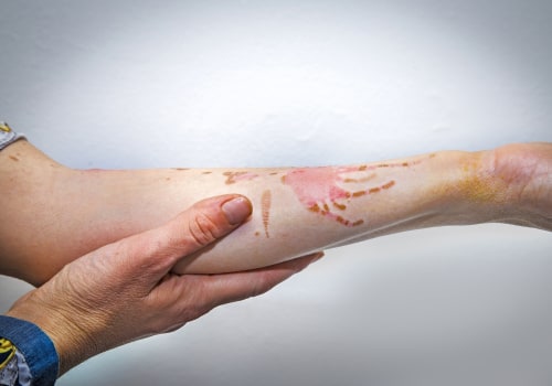 The Dangers of Leaving a Second-Degree Burn Untreated