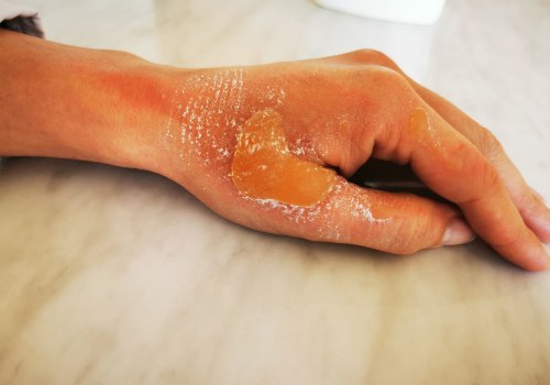 The Different Degrees of Burns: Understanding and Treating Them