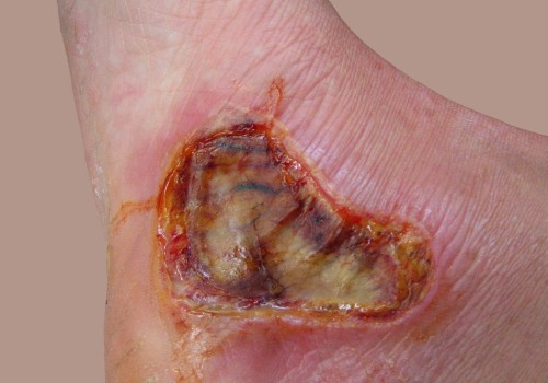 The Healing Process of 3rd Degree Burns